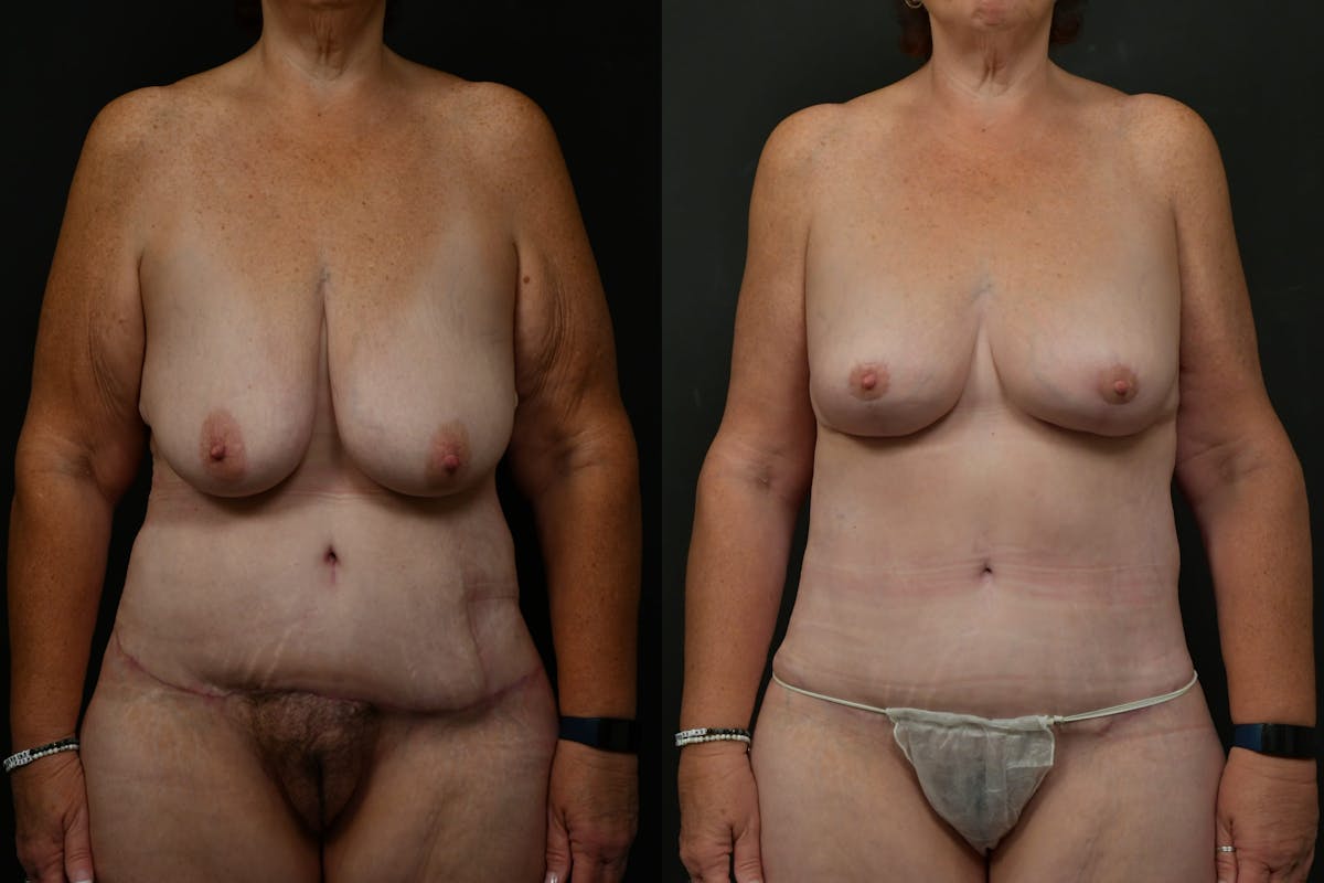 Non-Surgical Before & After Gallery - Patient 126798 - Image 5