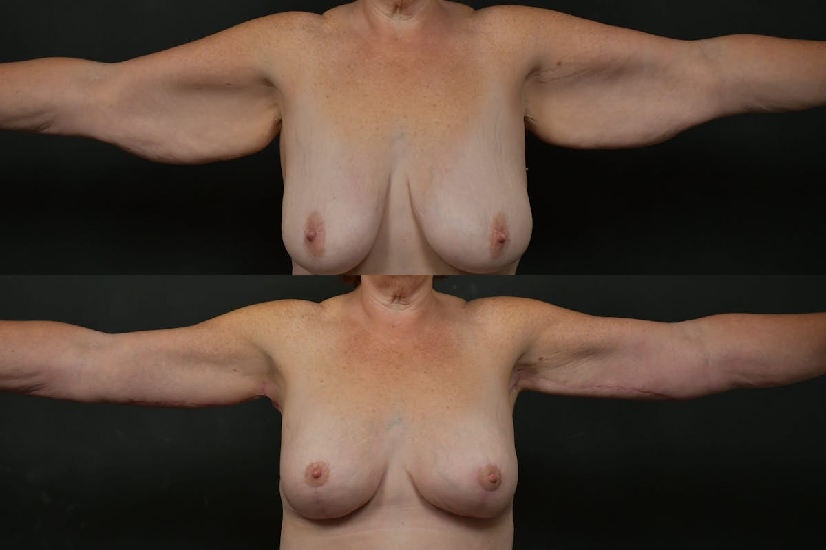 Non-Surgical Before & After Gallery - Patient 126798 - Image 7