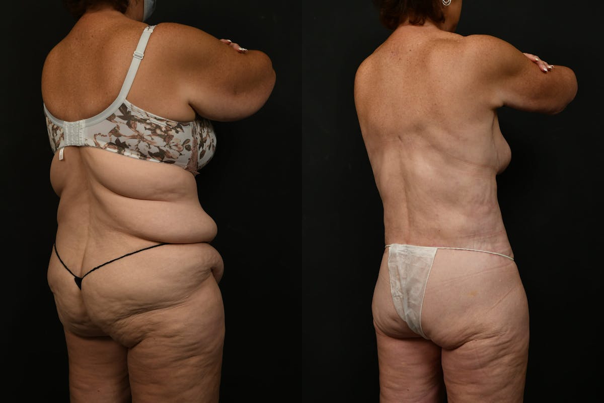 Non-Surgical Before & After Gallery - Patient 126798 - Image 10