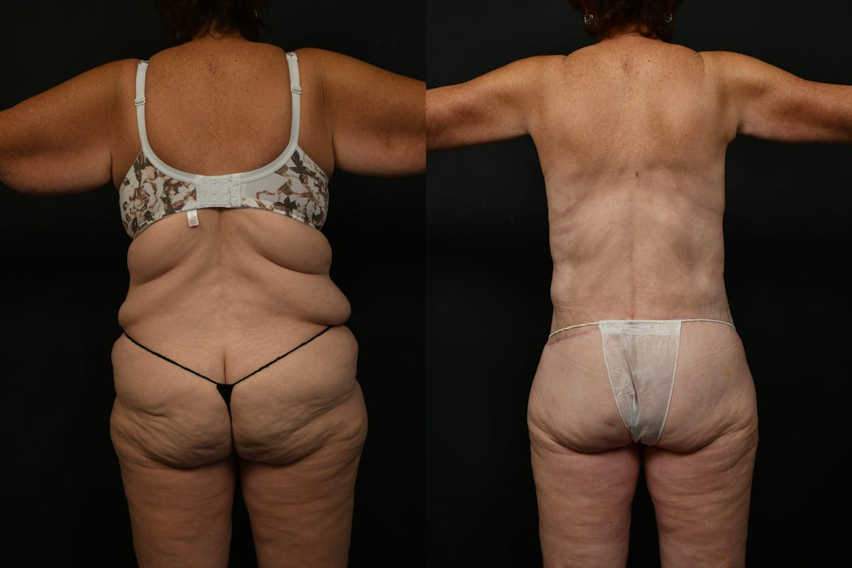 Non-Surgical Before & After Gallery - Patient 126798 - Image 11