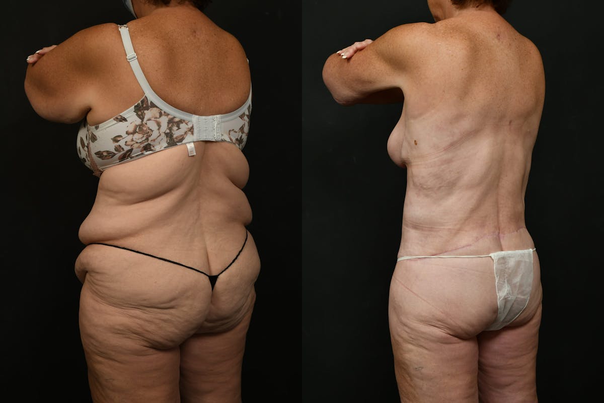 Non-Surgical Before & After Gallery - Patient 126798 - Image 12