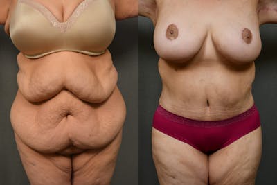 Massive Weight Loss Before & After Gallery - Patient 323803 - Image 1