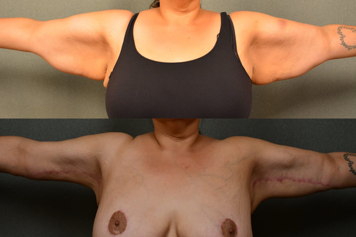 Massive Weight Loss Before & After Gallery - Patient 323803 - Image 6