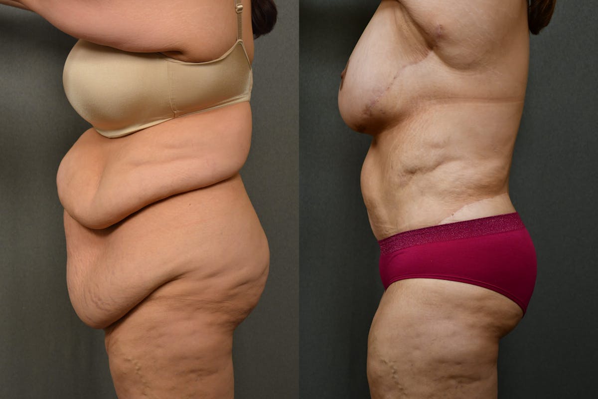 Massive Weight Loss Before & After Gallery - Patient 323803 - Image 2