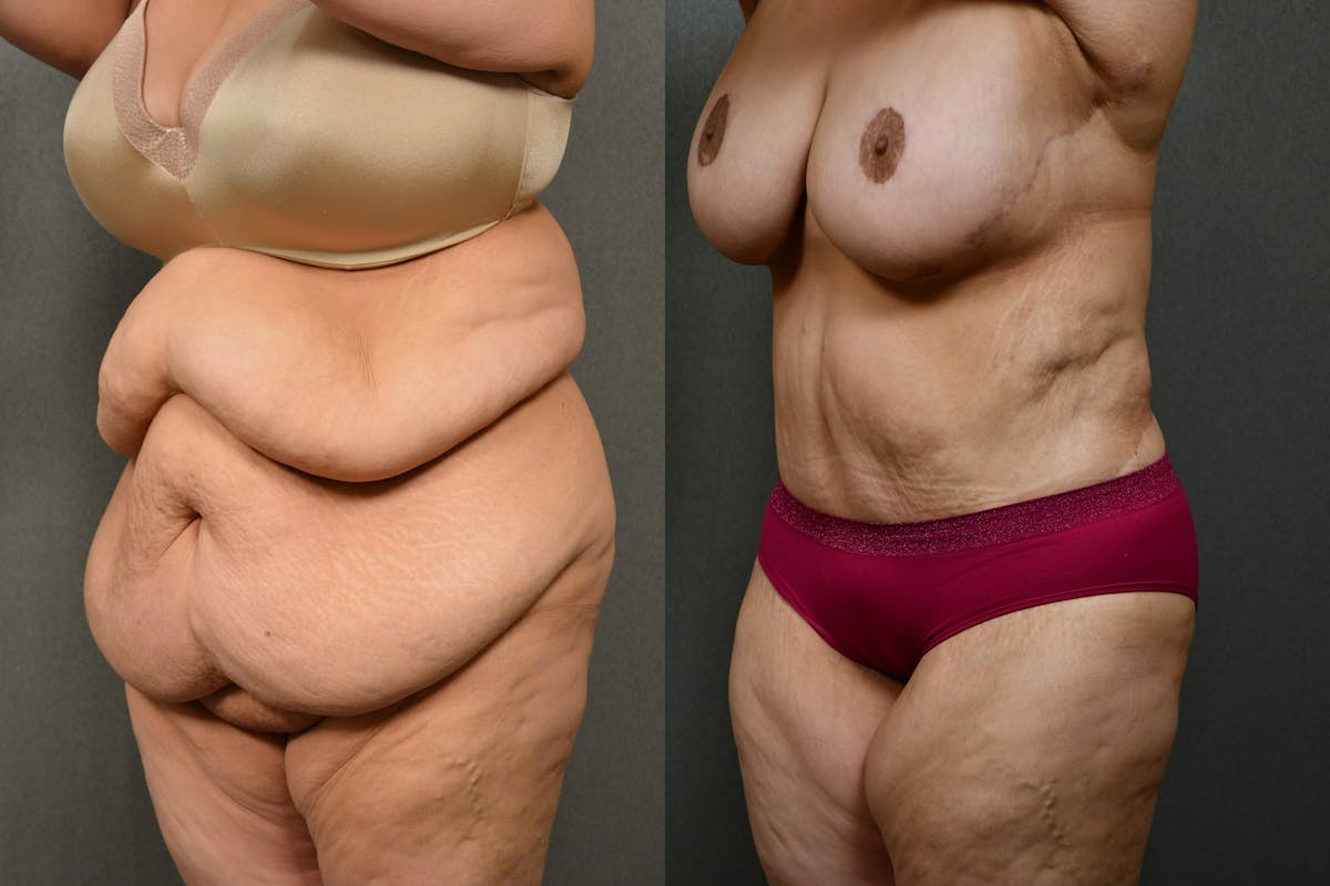 Massive Weight Loss Before & After Gallery - Patient 323803 - Image 3