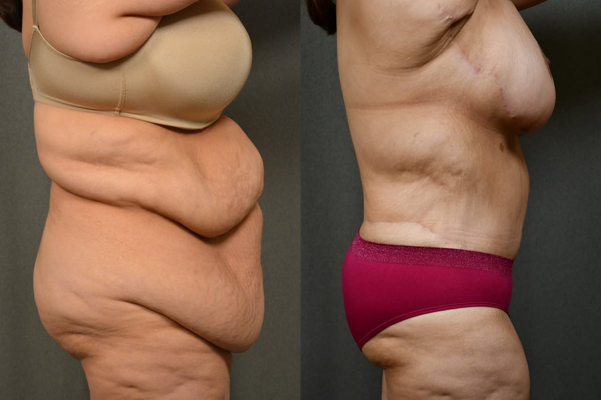 Massive Weight Loss Before & After Gallery - Patient 323803 - Image 4