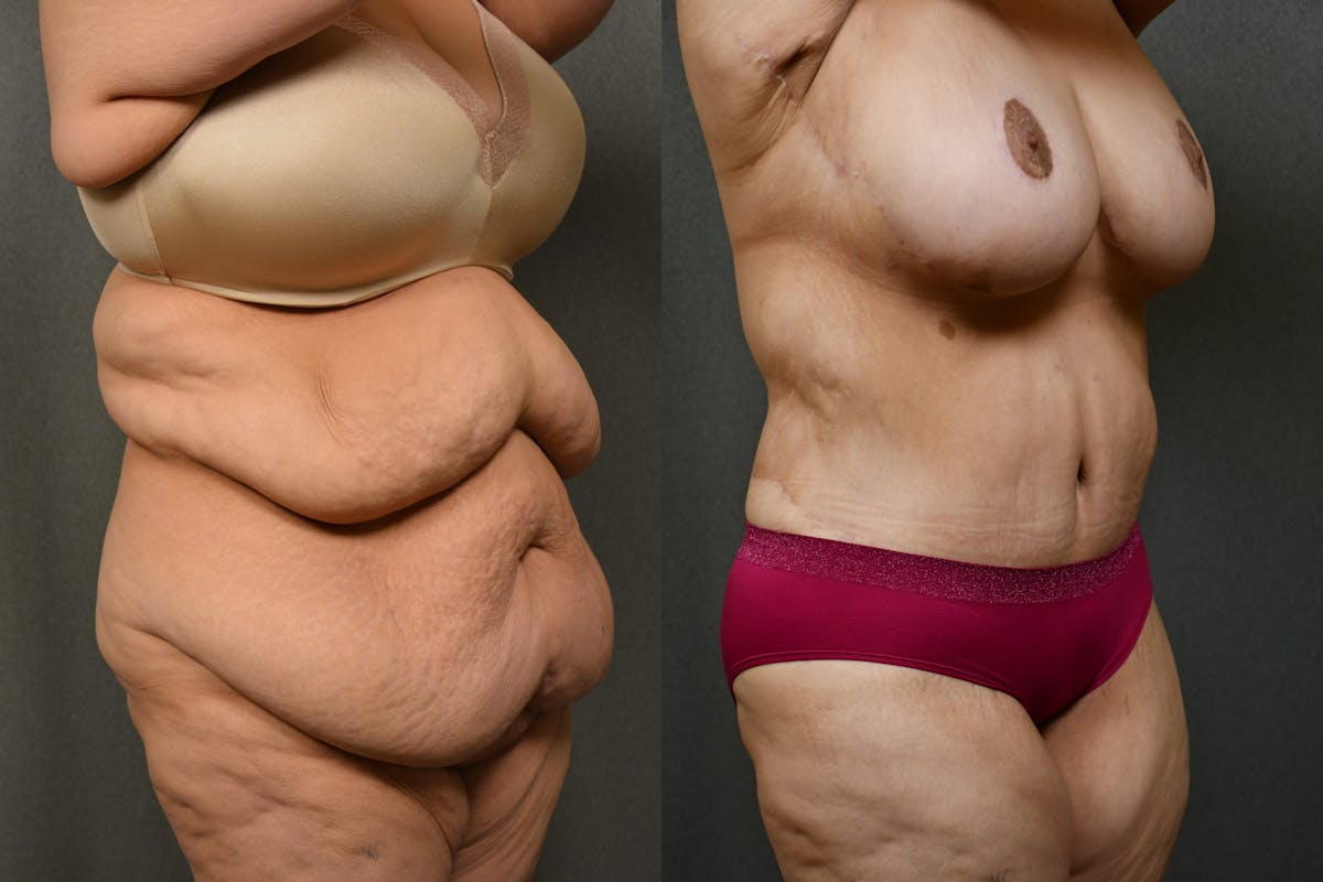Massive Weight Loss Before & After Gallery - Patient 323803 - Image 5