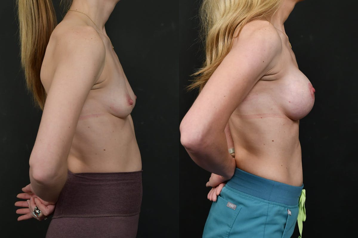 Breast Lift with Augmentation Before & After Gallery - Patient 133691 - Image 5