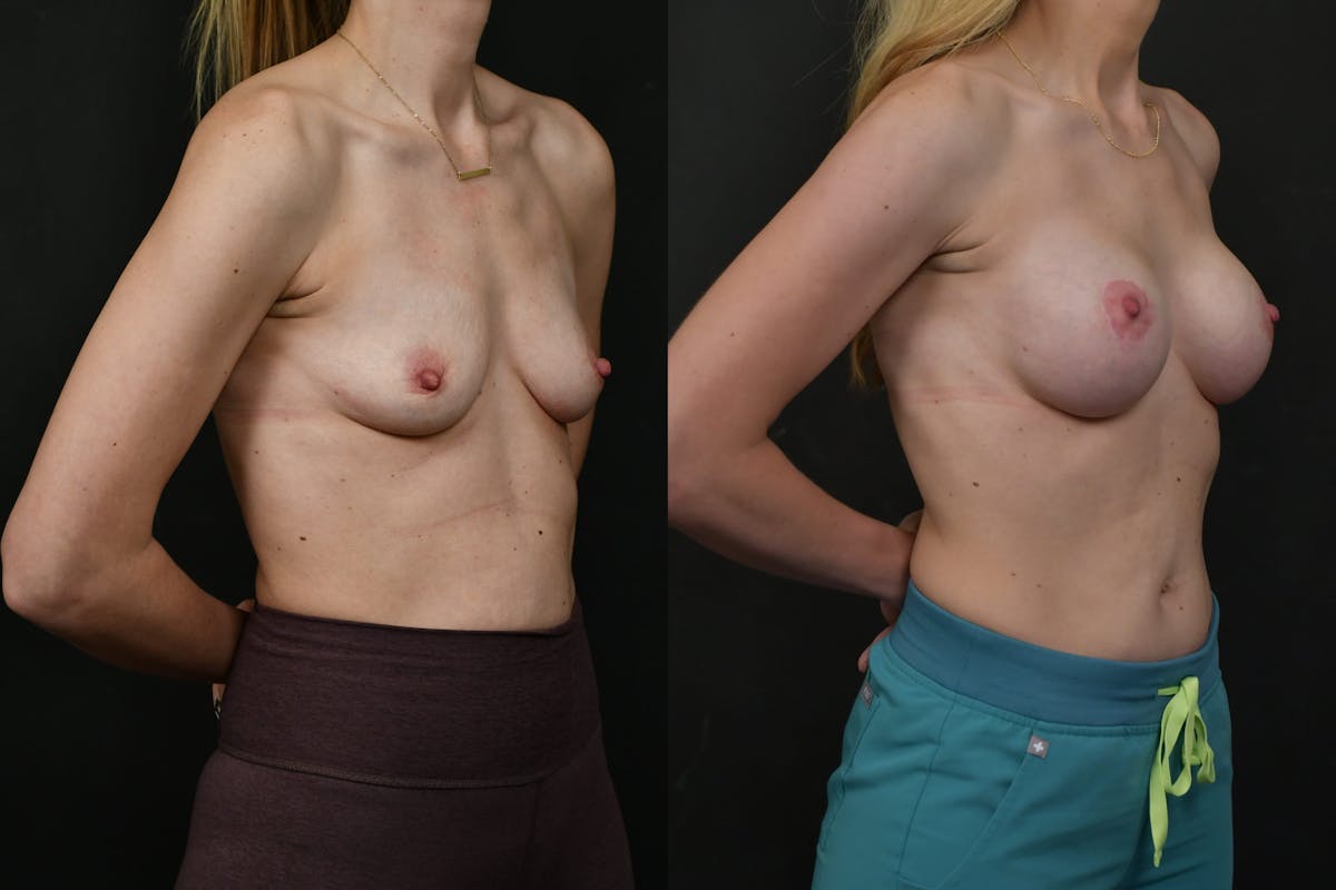 Breast Lift with Augmentation Before & After Gallery - Patient 133691 - Image 4