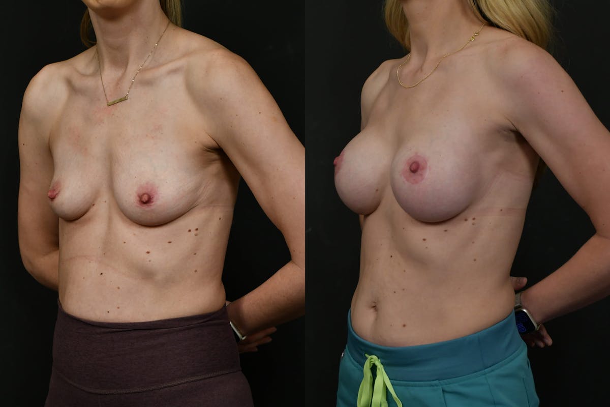 Breast Lift with Augmentation Before & After Gallery - Patient 133691 - Image 2