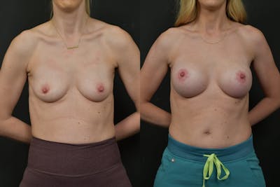 Breast Lift Before & After Gallery - Patient 122565 - Image 1