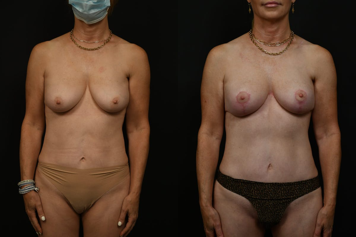 Breast Lift Before & After Gallery - Patient 261769 - Image 1