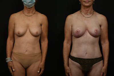 Breast Lift Before & After Gallery - Patient 261769 - Image 1