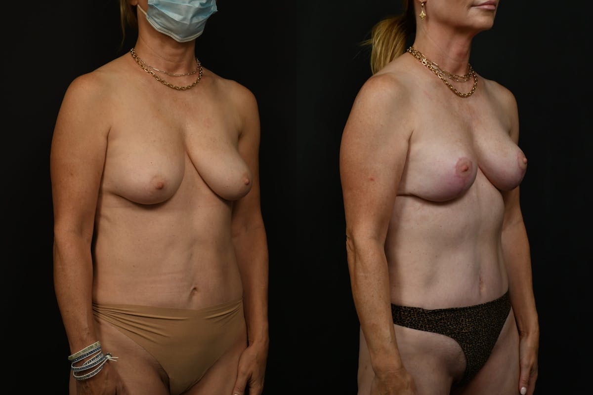 Breast Lift Before & After Gallery - Patient 261769 - Image 2