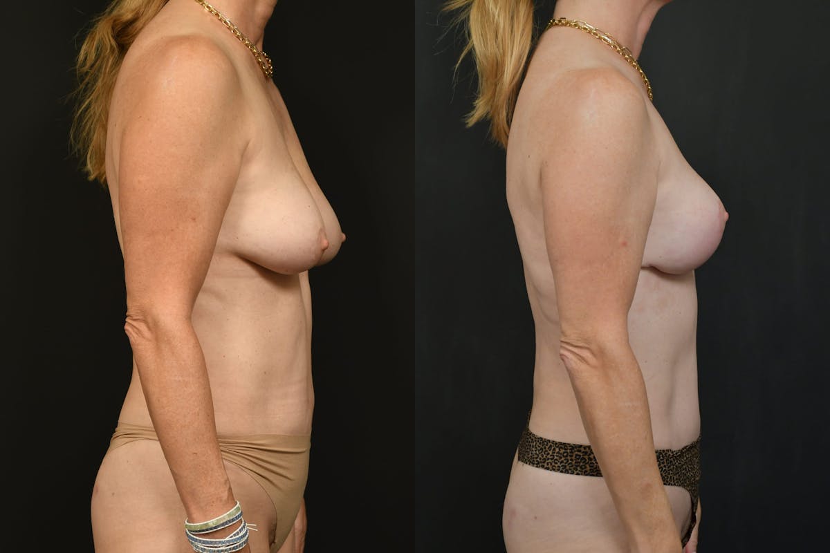 Breast Lift Before & After Gallery - Patient 261769 - Image 3