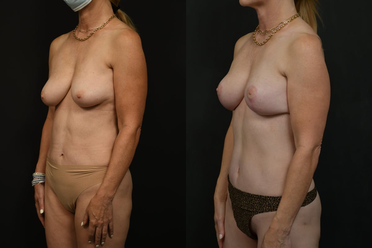 Breast Lift Before & After Gallery - Patient 261769 - Image 4