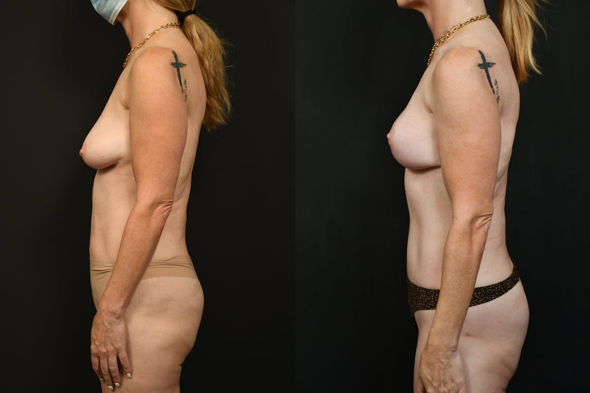 Breast Lift Before & After Gallery - Patient 261769 - Image 5