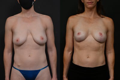 Breast Lift Before & After Gallery - Patient 128104 - Image 1