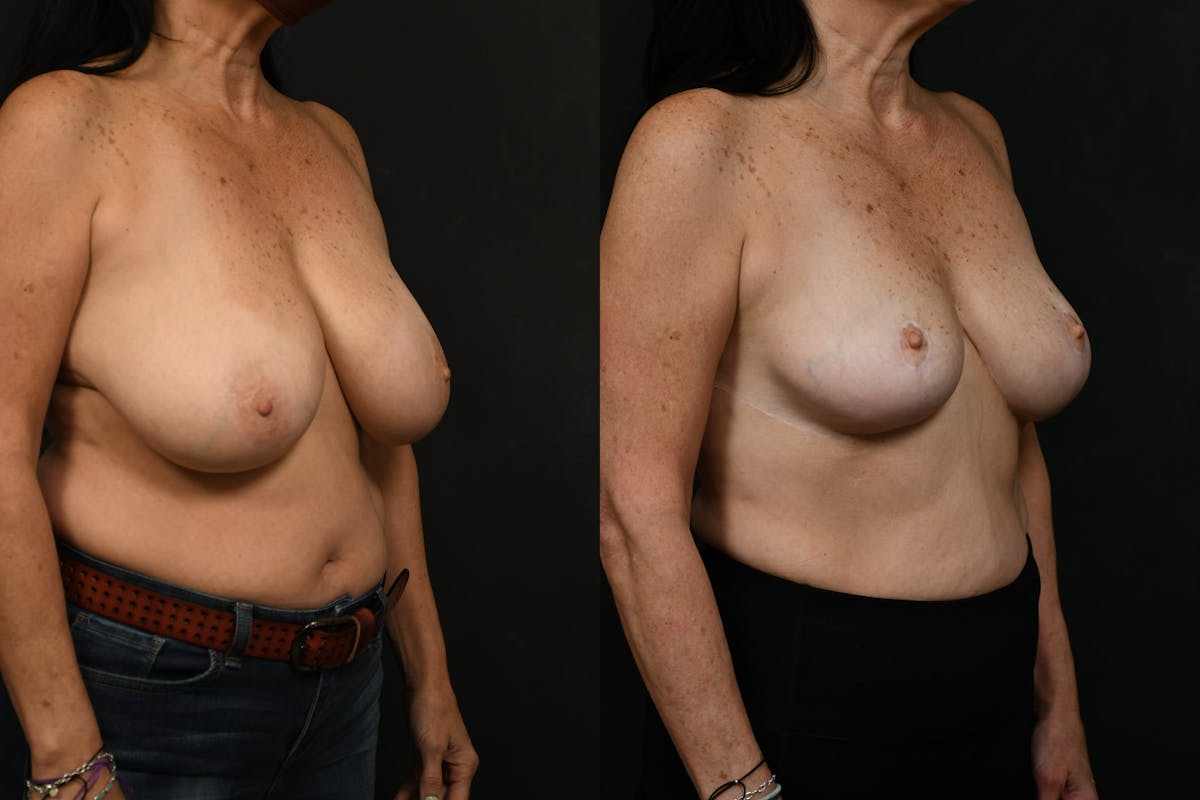 Breast Lift Before & After Gallery - Patient 416606 - Image 4