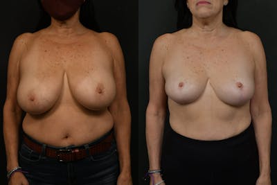 Breast Lift Before & After Gallery - Patient 416606 - Image 1