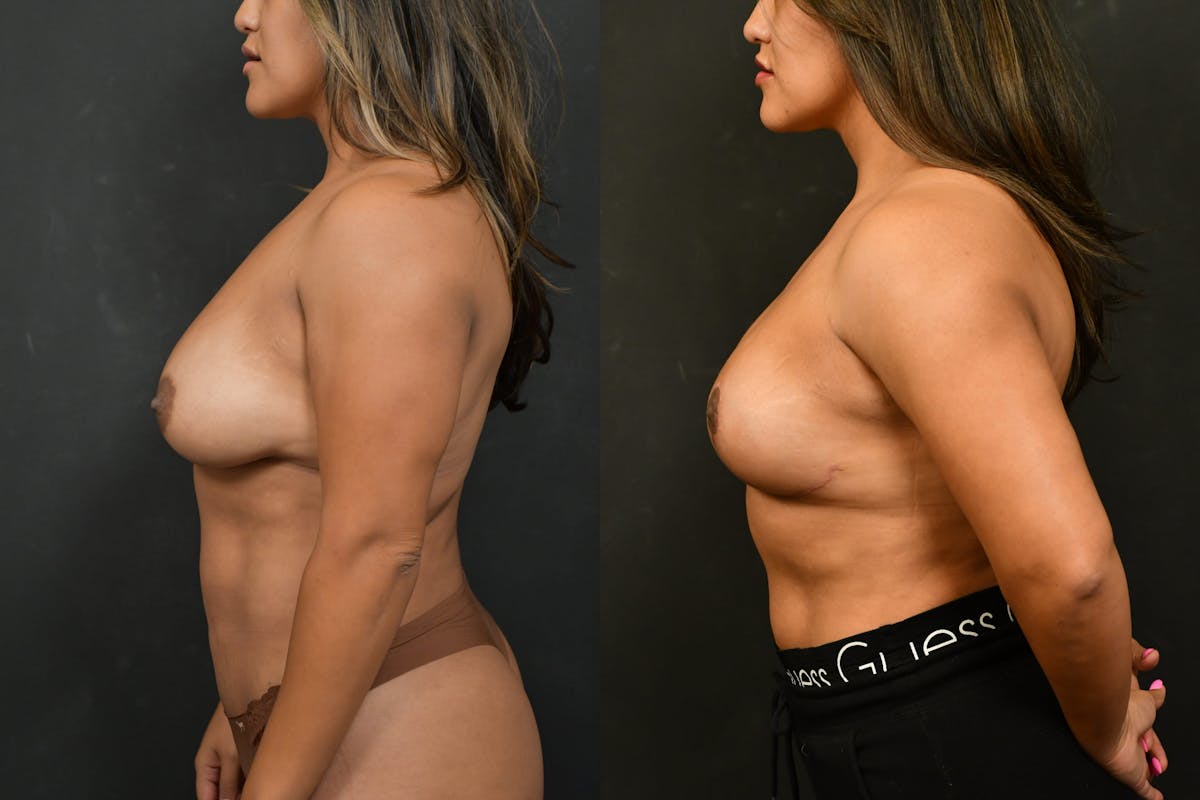 Breast Lift Before & After Gallery - Patient 752807 - Image 3