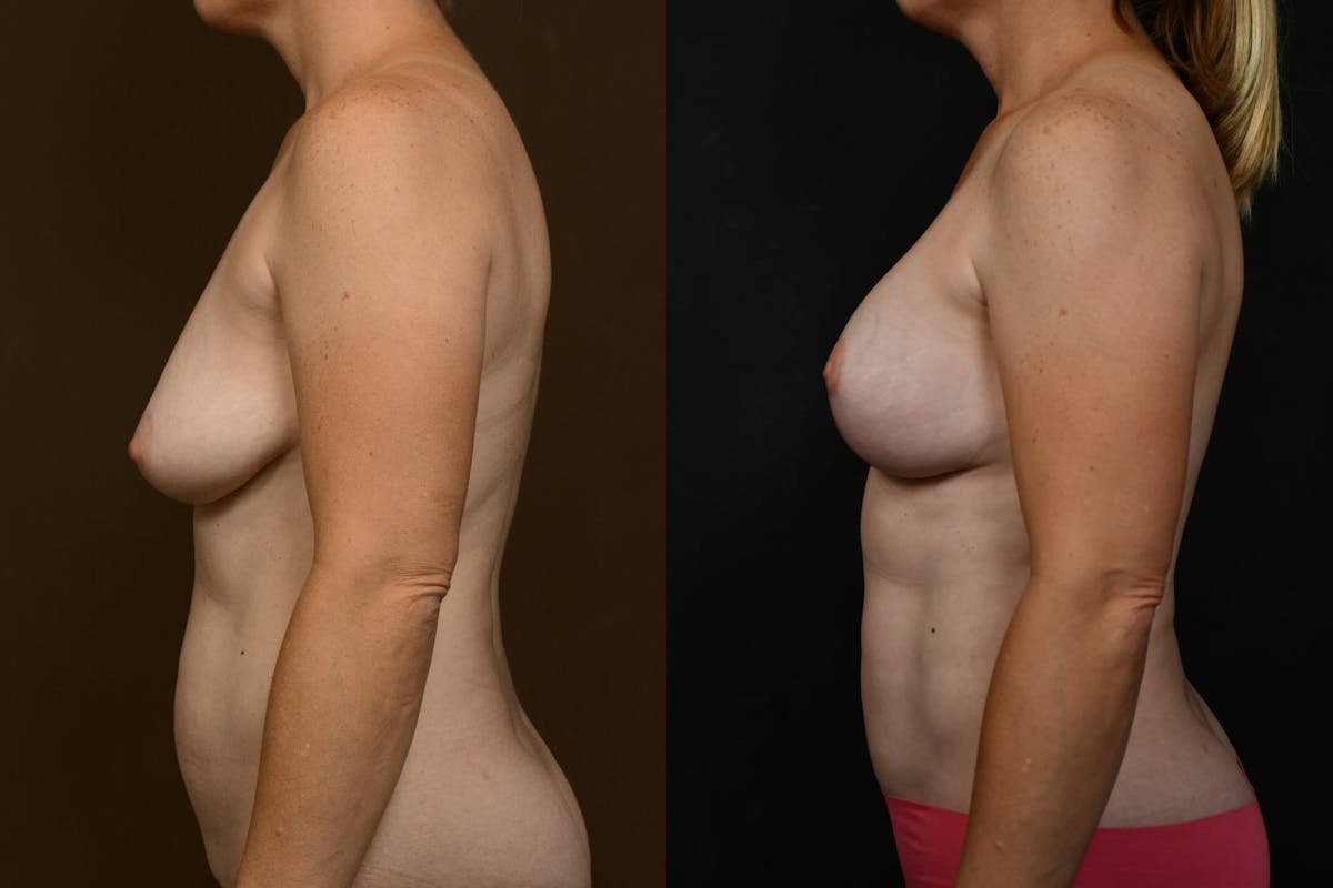 Breast Lift Before & After Gallery - Patient 120883 - Image 3