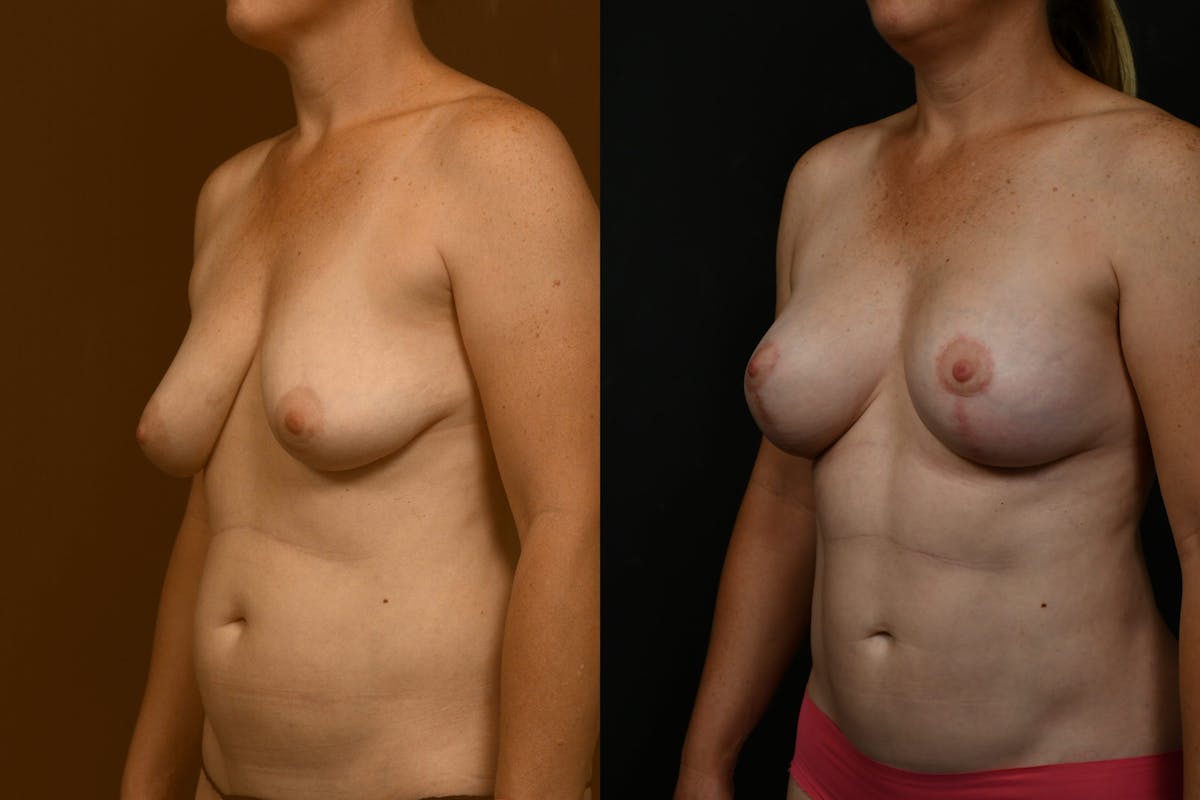 Breast Lift Before & After Gallery - Patient 120883 - Image 2
