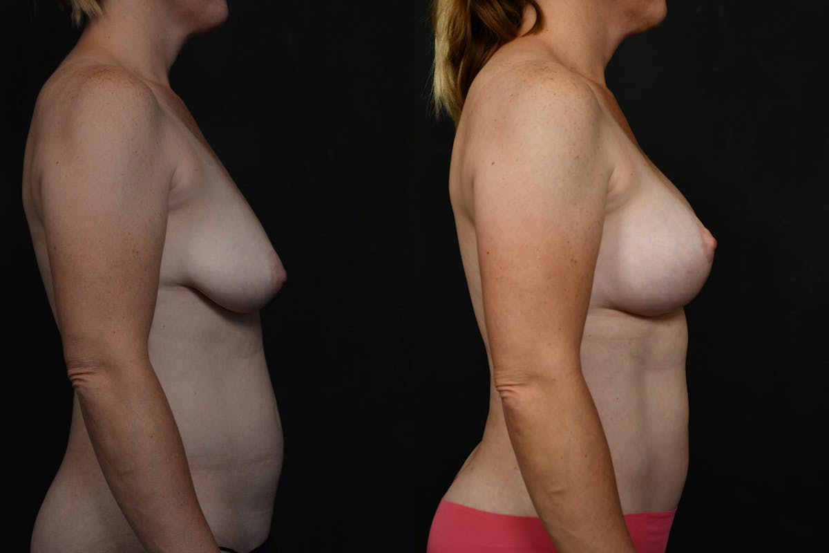 Breast Lift Before & After Gallery - Patient 120883 - Image 5