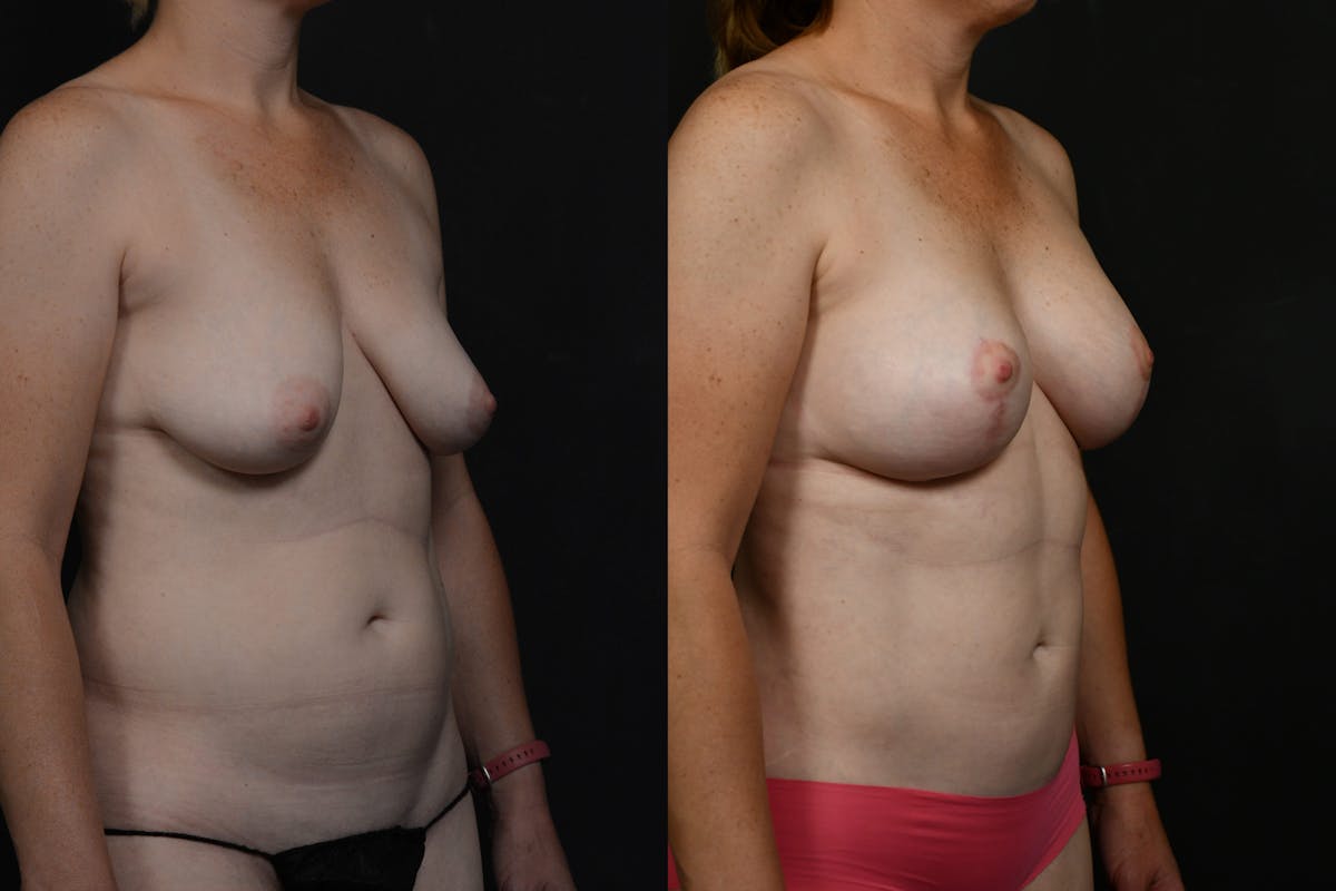 Breast Lift Before & After Gallery - Patient 120883 - Image 4