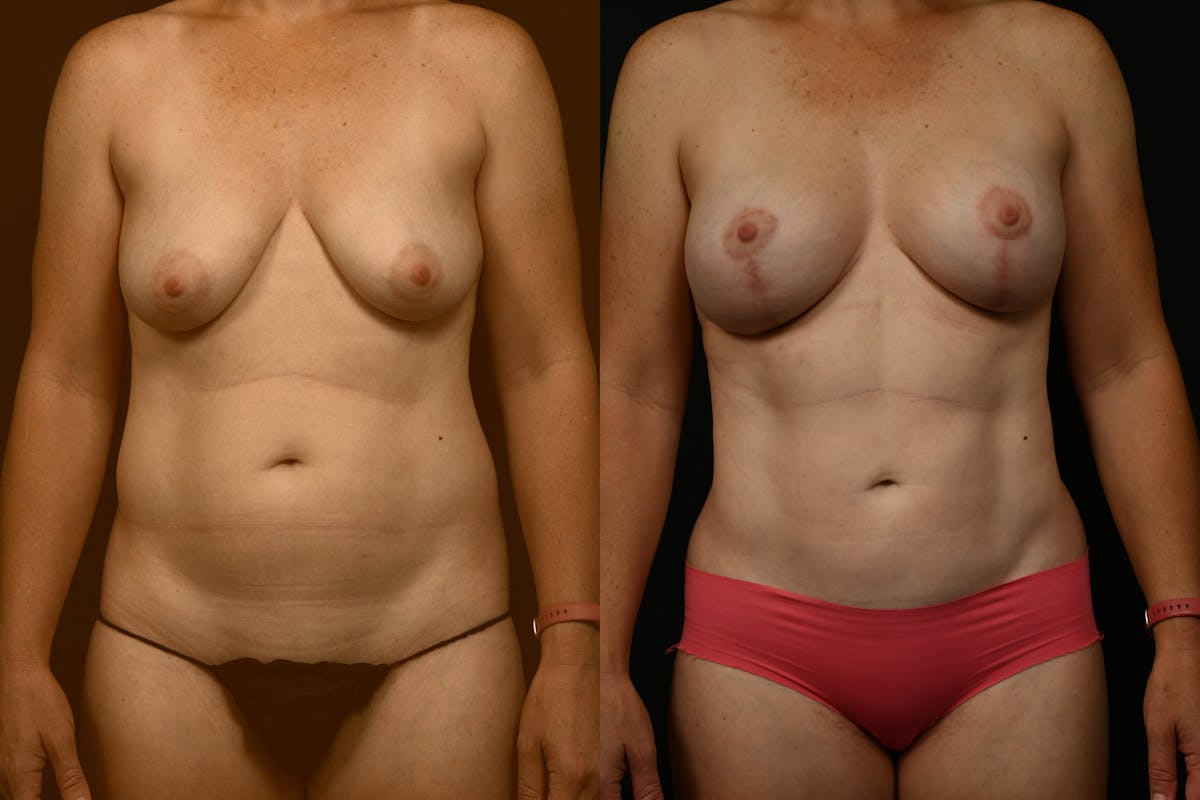 Reductive Augmentation Before & After Gallery - Patient 245341 - Image 1