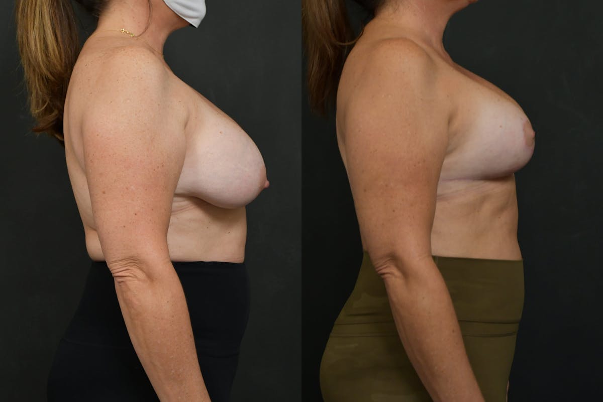 Breast Lift Before & After Gallery - Patient 160482 - Image 5