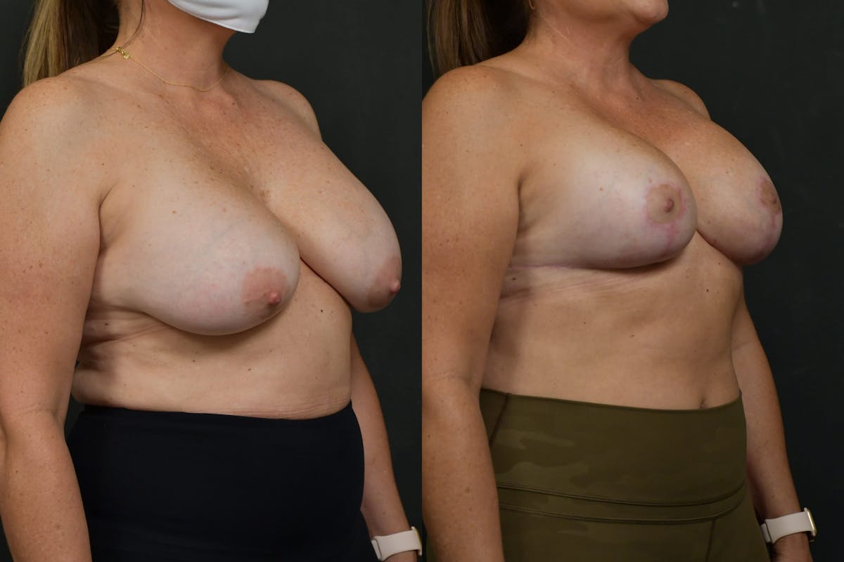 Reductive Augmentation Before & After Gallery - Patient 403576 - Image 4