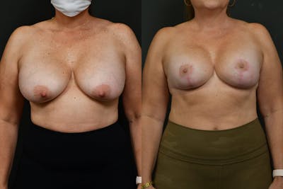 Reductive Augmentation Before & After Gallery - Patient 403576 - Image 1