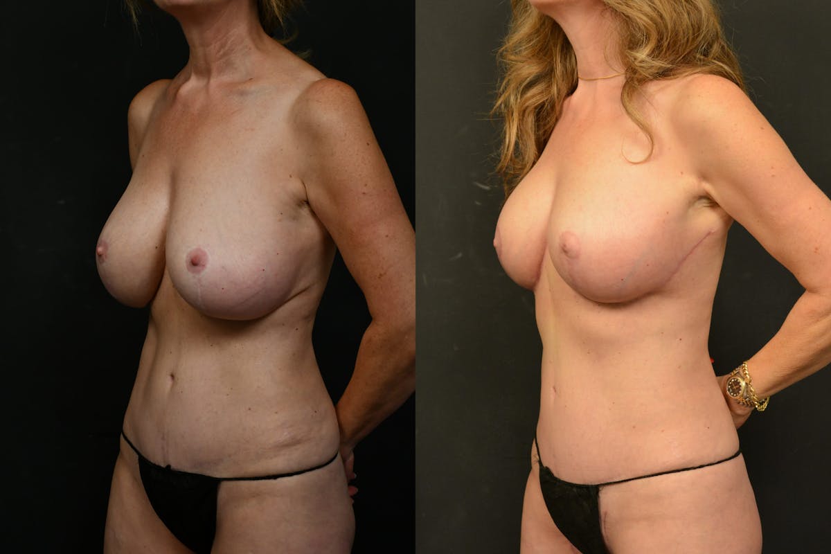 Breast Lift Before & After Gallery - Patient 150546 - Image 2