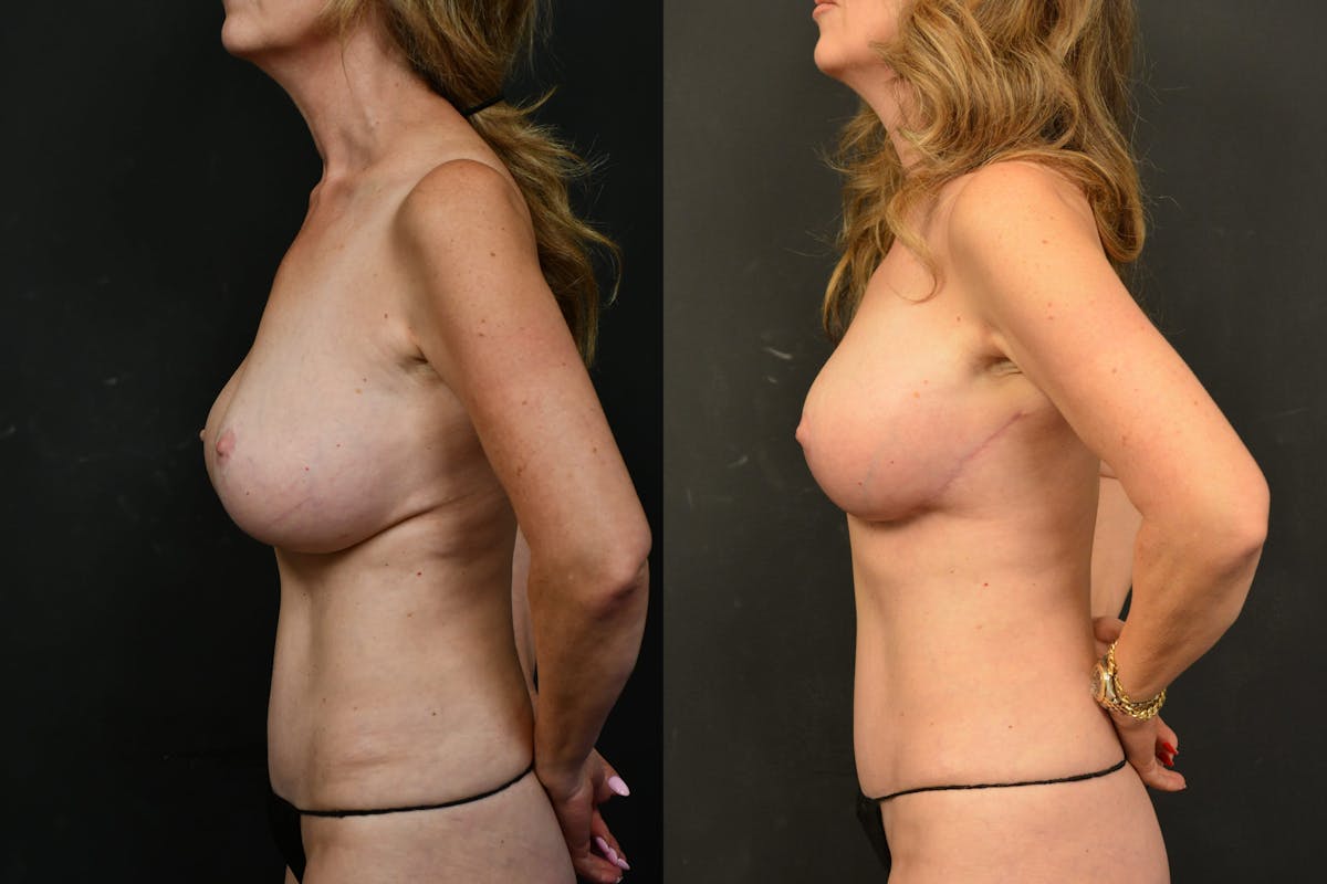 Breast Lift Before & After Gallery - Patient 150546 - Image 3
