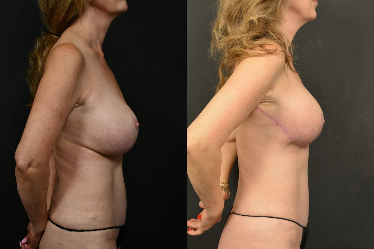 Breast Lift Before & After Gallery - Patient 150546 - Image 5