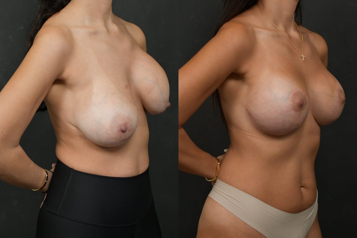 Breast Revision Before & After Gallery - Patient 305402 - Image 2