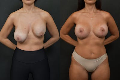 Breast Revision Before & After Gallery - Patient 305402 - Image 1