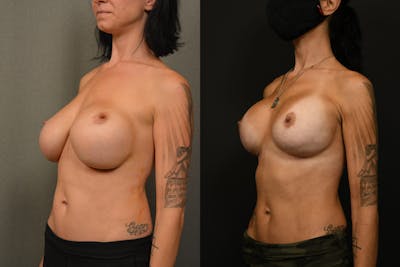 Breast Revision Before & After Gallery - Patient 705844 - Image 1