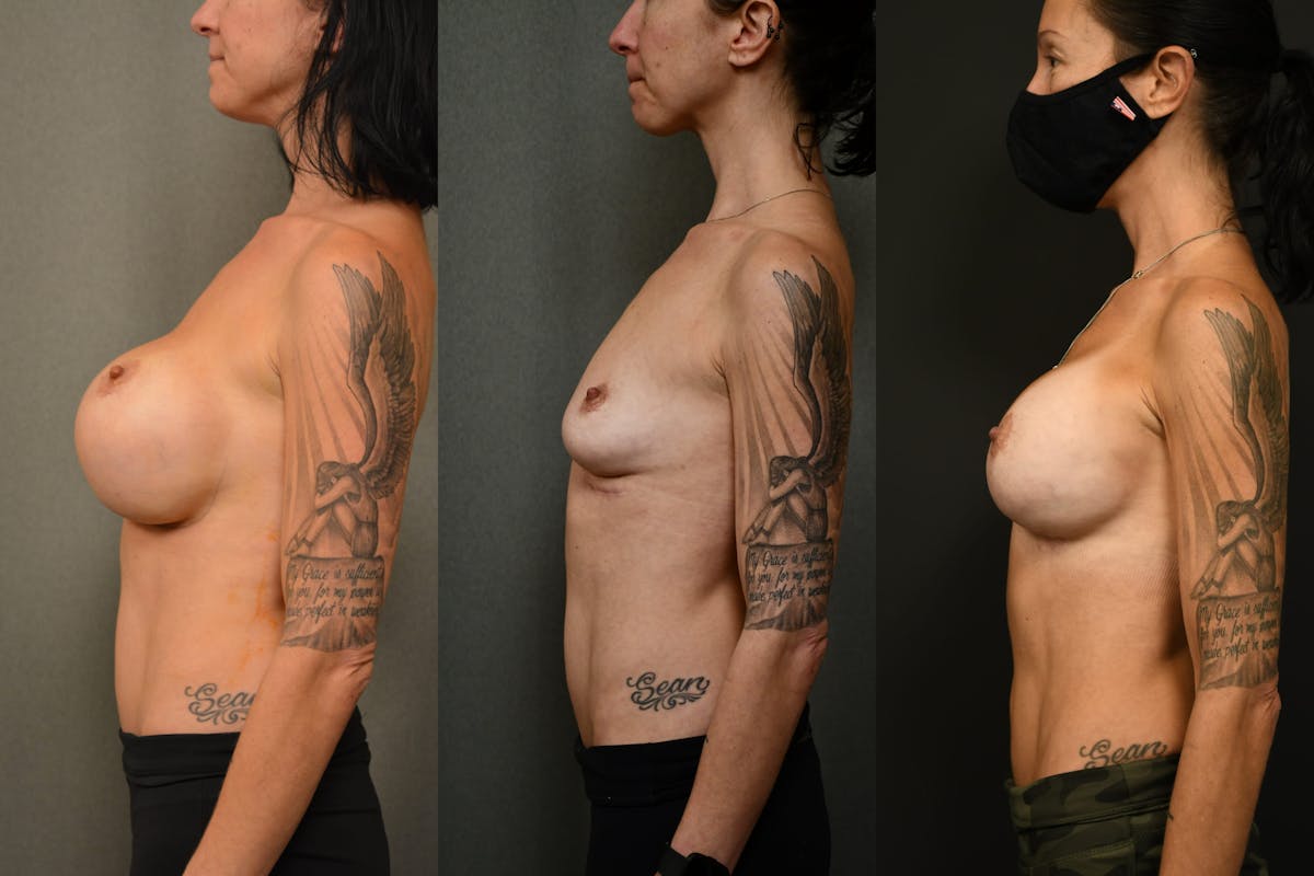 Breast Revision Before & After Gallery - Patient 705844 - Image 5