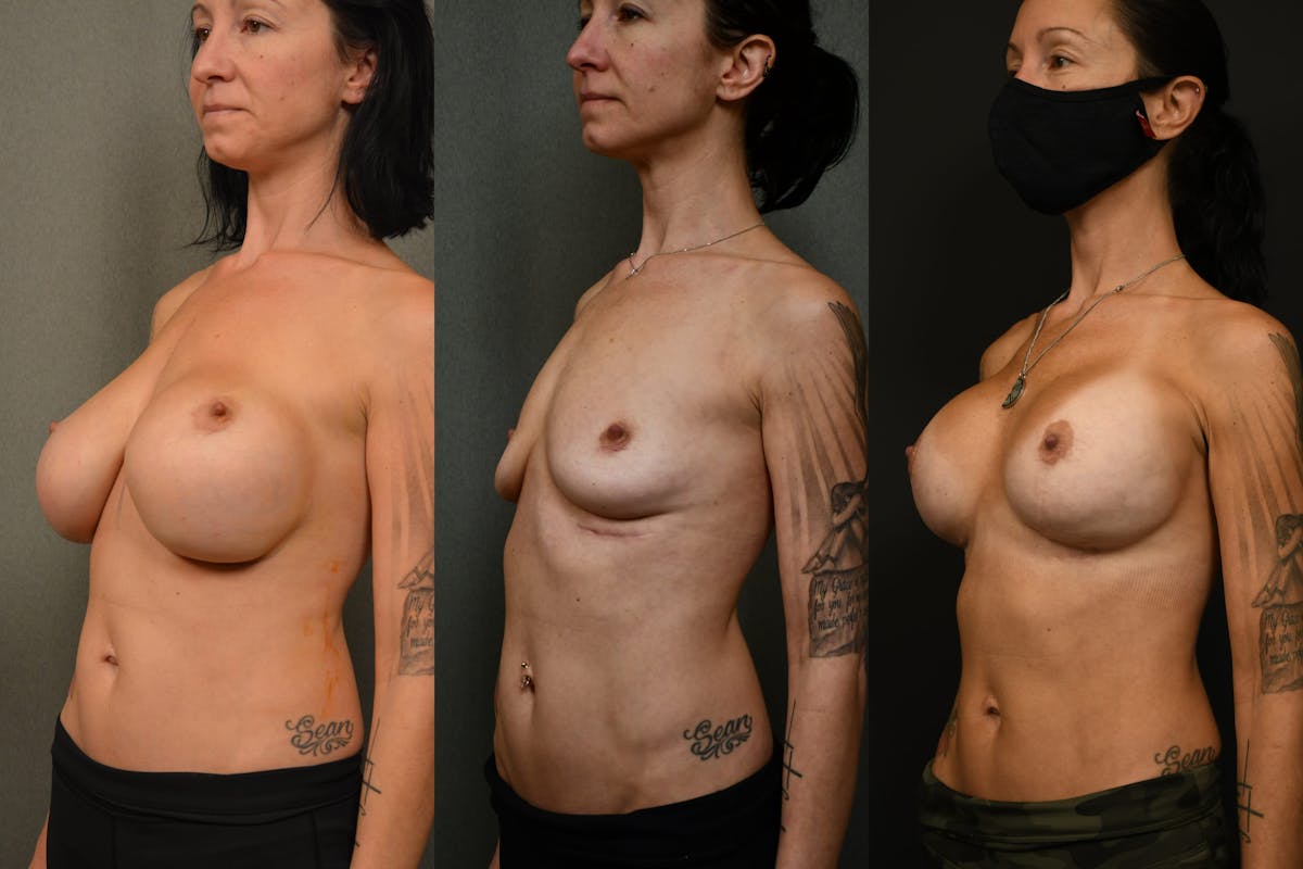 Breast Revision Before & After Gallery - Patient 705844 - Image 6