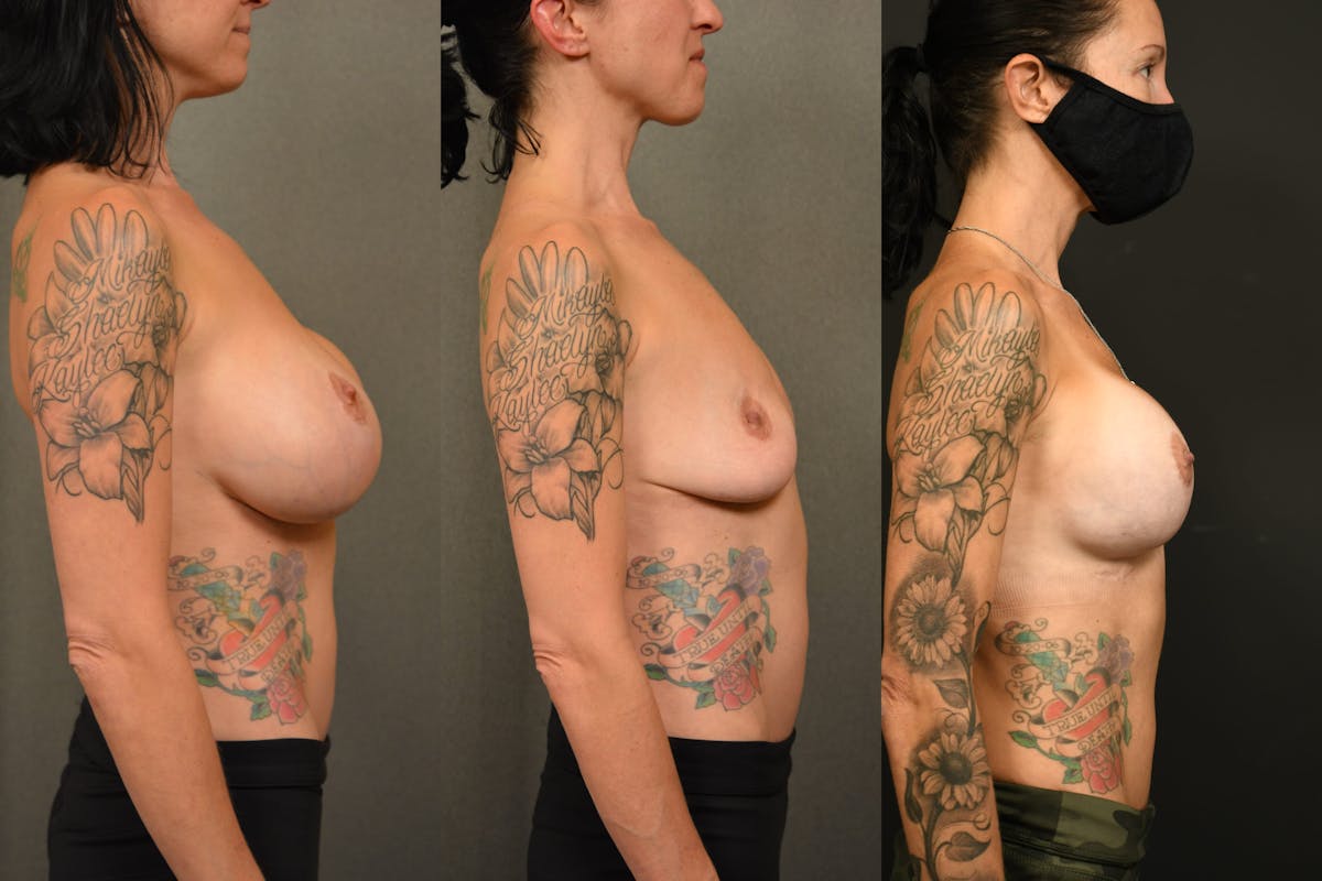 Breast Revision Before & After Gallery - Patient 705844 - Image 7