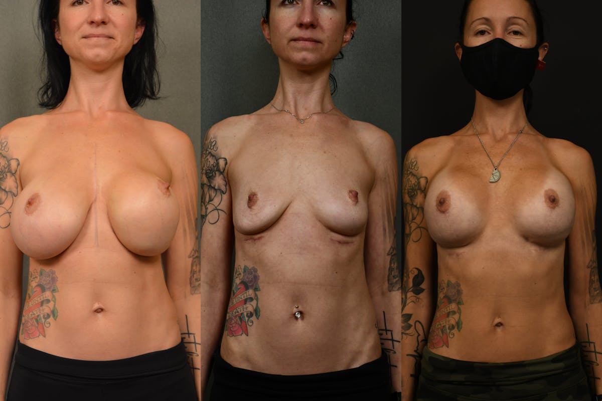 Breast Revision Before & After Gallery - Patient 705844 - Image 9