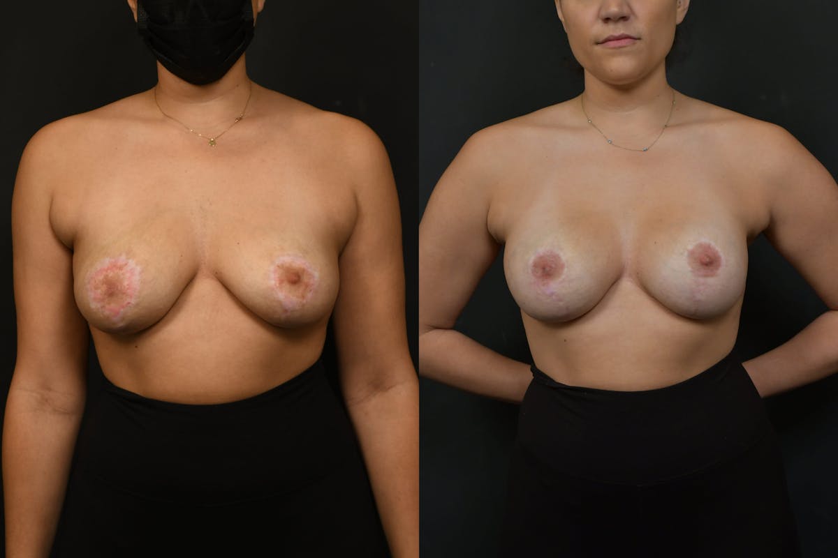 Breast Revision Before & After Gallery - Patient 925107 - Image 1