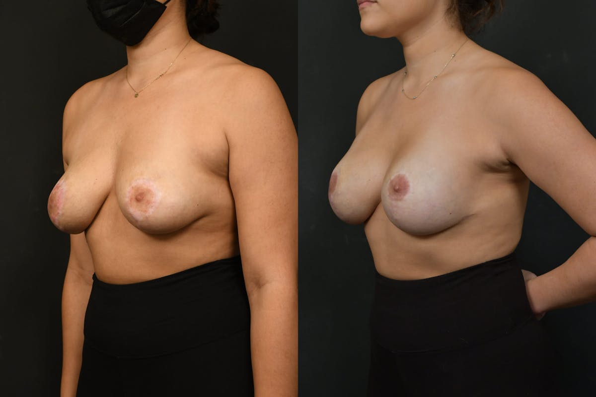 Breast Revision Before & After Gallery - Patient 925107 - Image 2
