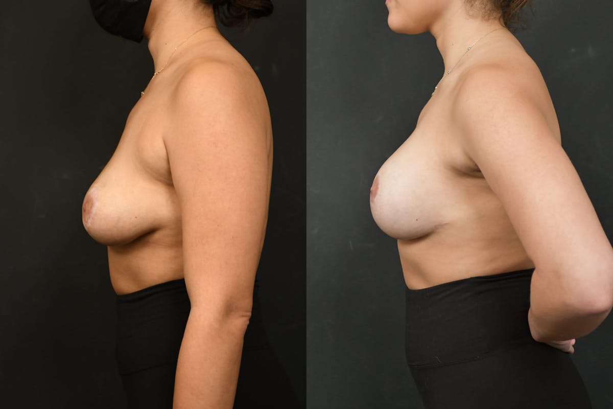 Breast Revision Before & After Gallery - Patient 925107 - Image 3