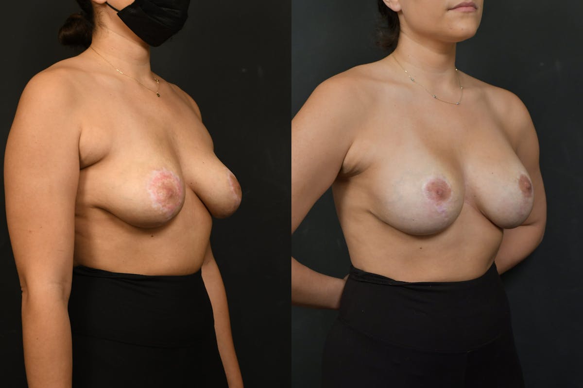 Breast Revision Before & After Gallery - Patient 925107 - Image 4