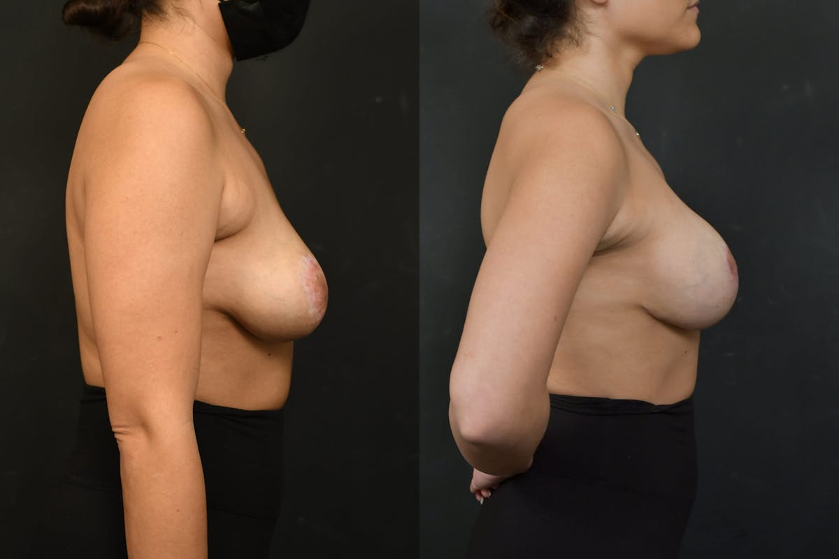 Breast Revision Before & After Gallery - Patient 925107 - Image 5