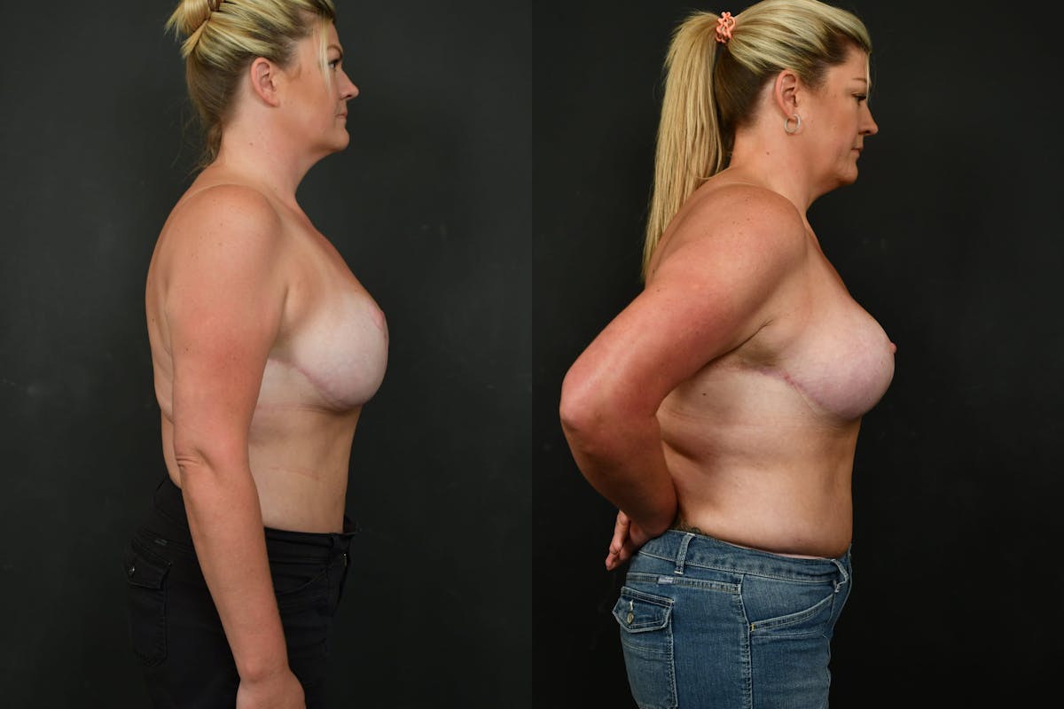 Breast Revision Before & After Gallery - Patient 252164 - Image 3