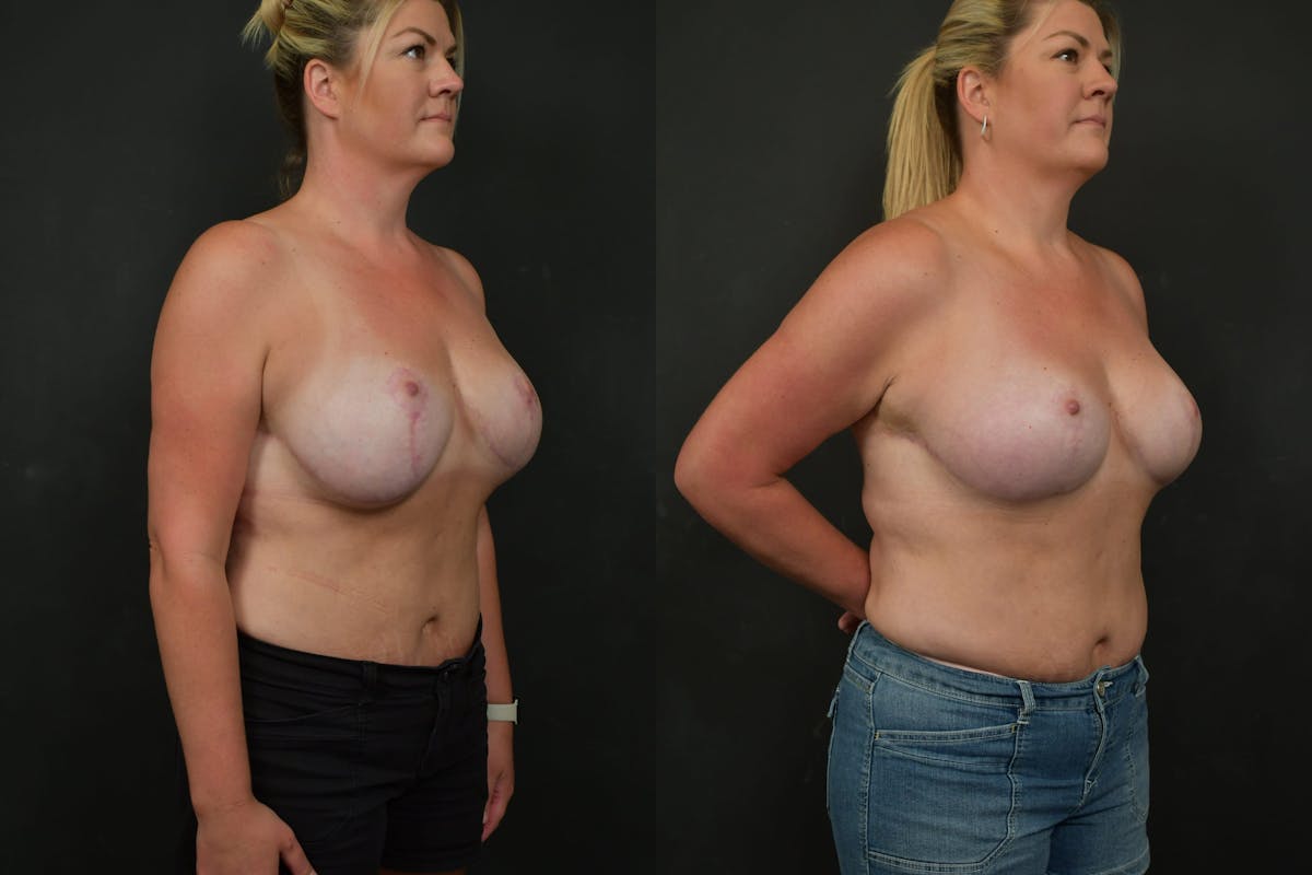 Breast Revision Before & After Gallery - Patient 252164 - Image 2